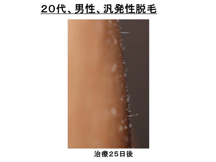円形脱毛症　病院